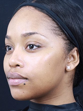 Dermal Fillers Before & After