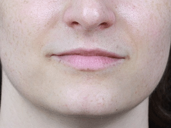 Dermal Fillers Before & After