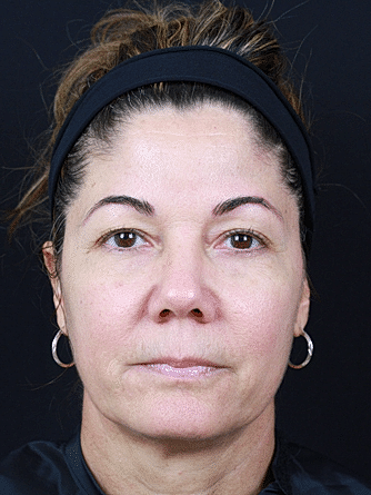 Dermal Fillers Before & After