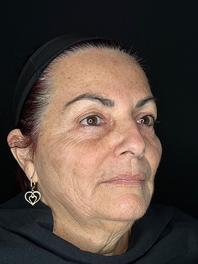 Dermal Fillers  Before & After