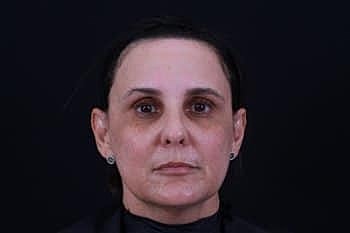 Botox & Dysport Before & After