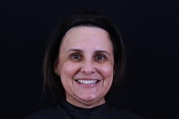 Botox & Dysport Before & After