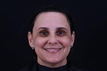 Botox & Dysport Before & After