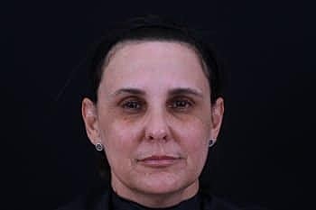 Botox & Dysport Before & After