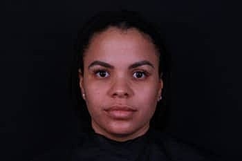 Botox & Dysport Before & After