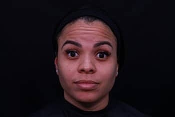 Botox & Dysport Before & After