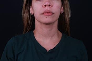 Botox & Dysport Before & After