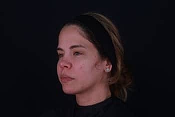 Botox & Dysport Before & After