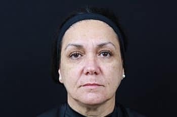 Botox & Dysport Before & After