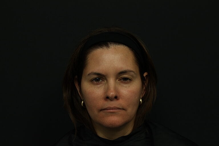 Botox & Dysport Before & After