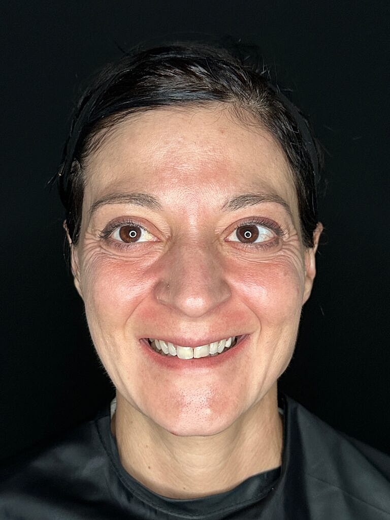 Botox & Dysport Before & After