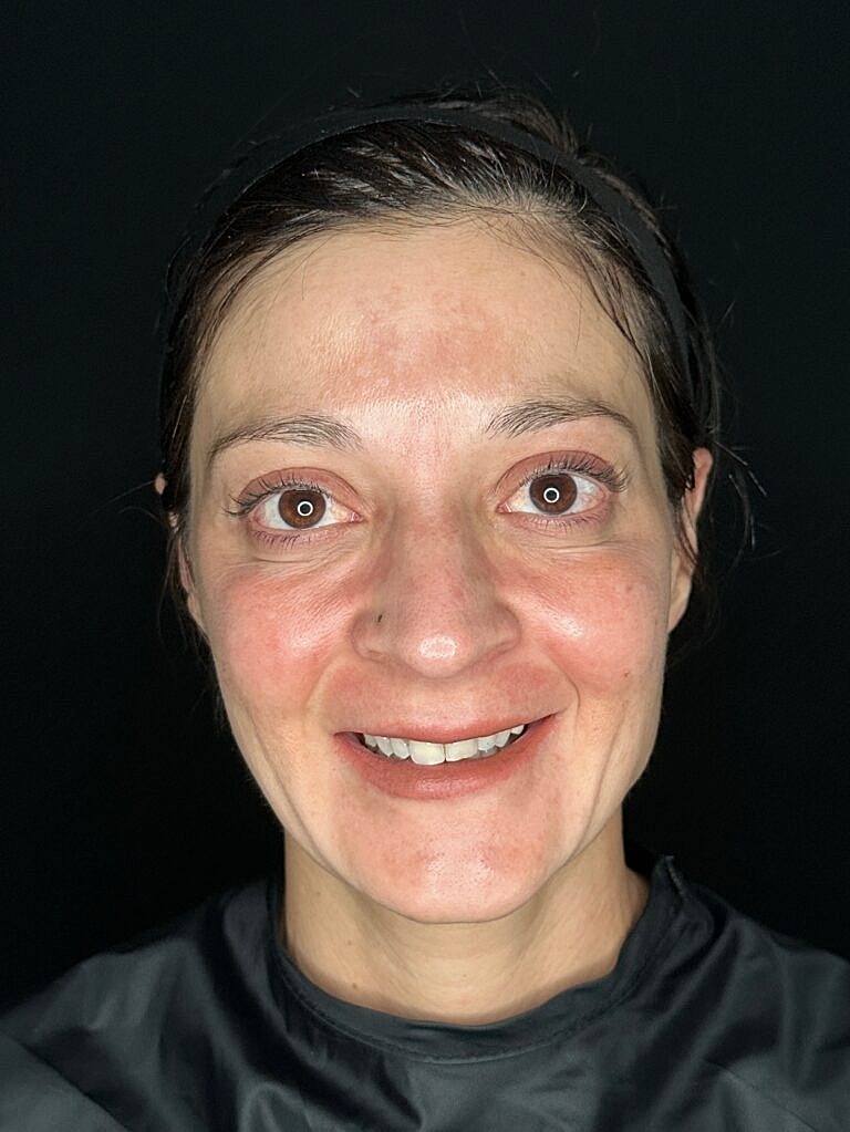 Botox & Dysport Before & After