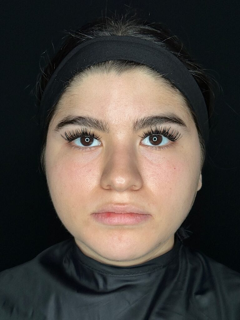 Botox & Dysport Before & After