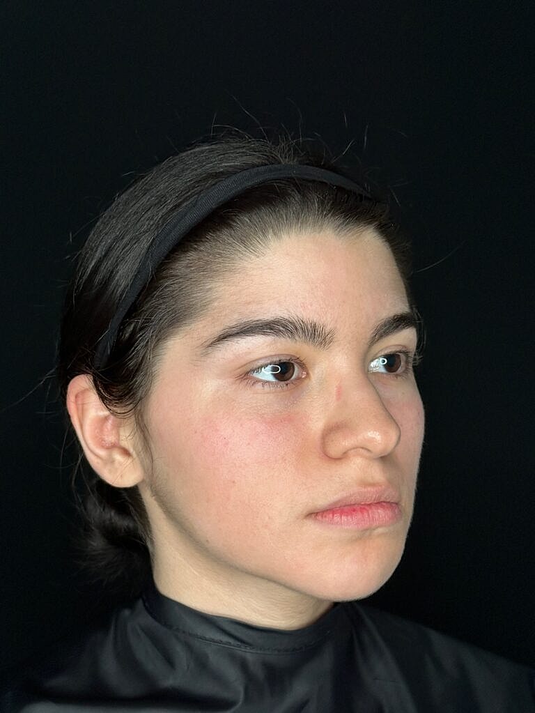 Botox & Dysport Before & After