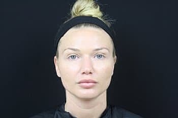 Botox & Dysport Before & After