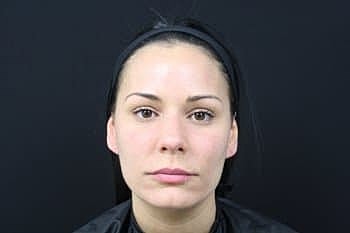 Botox & Dysport Before & After