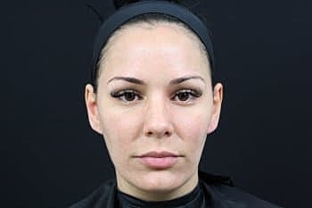 Botox & Dysport Before & After