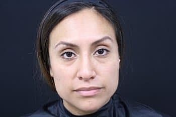 Botox & Dysport Before & After