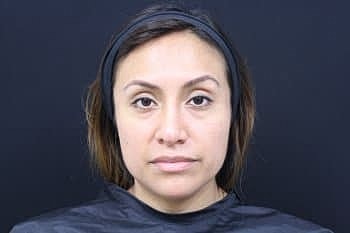 Botox & Dysport Before & After