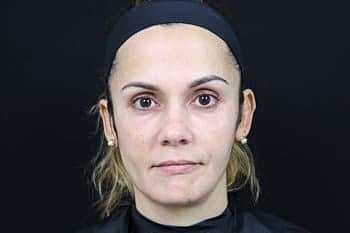 Botox & Dysport Before & After