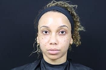 Botox & Dysport Before & After