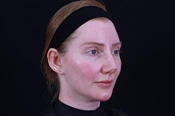 Botox & Dysport Before & After