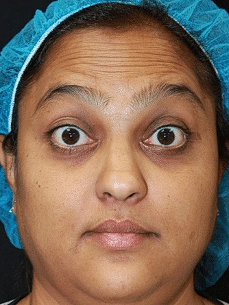 Botox & Dysport Before & After