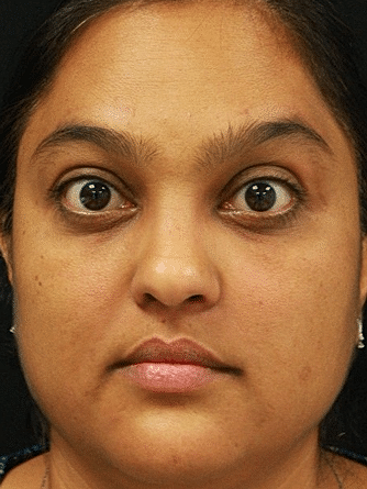 Botox & Dysport Before & After