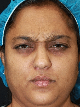 Botox & Dysport Before & After