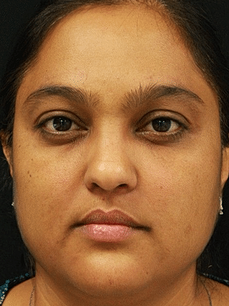 Botox & Dysport Before & After