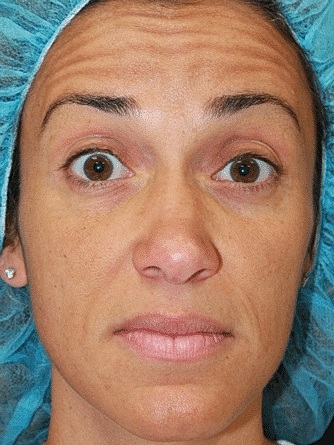 Botox & Dysport Before & After