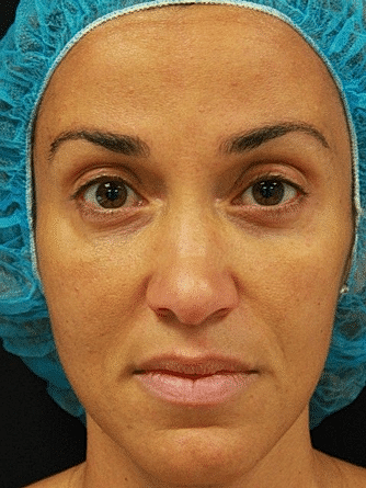 Botox & Dysport Before & After