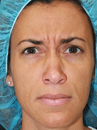 Botox & Dysport Before & After