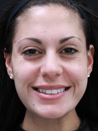 Botox & Dysport Before & After