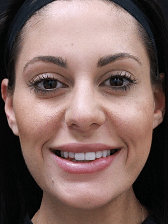 Botox & Dysport Before & After