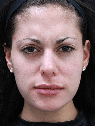 Botox & Dysport Before & After
