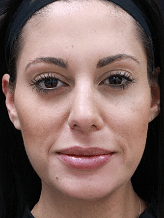 Botox & Dysport Before & After