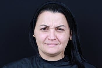 Botox & Dysport Before & After