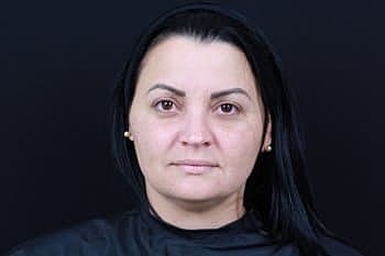 Botox & Dysport Before & After