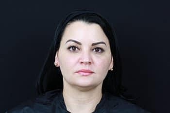 Botox & Dysport Before & After