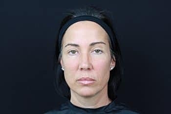 Botox & Dysport Before & After