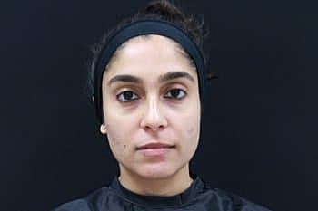 Botox & Dysport Before & After