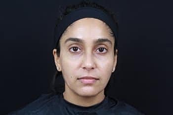 Botox & Dysport Before & After