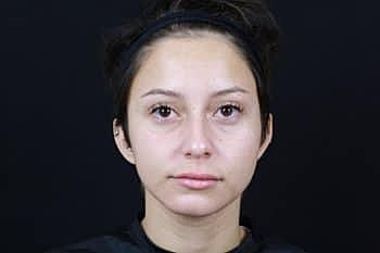 Botox & Dysport Before & After