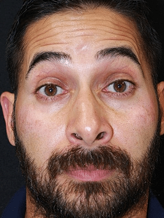 Botox & Dysport Before & After