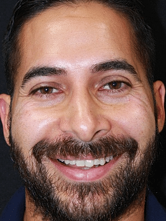 Botox & Dysport Before & After