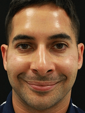 Botox & Dysport Before & After