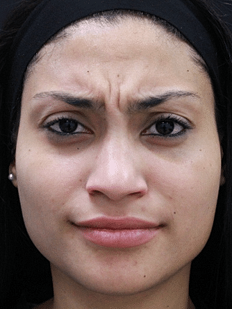 Botox & Dysport Before & After