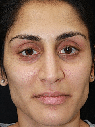 Botox & Dysport Before & After