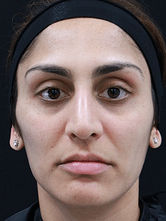 Botox & Dysport Before & After